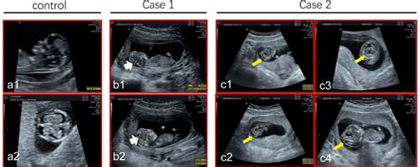 Prenatal ultrasound images. (a) Ultrasonography showed the brain of a ...