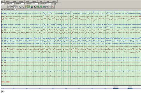 EEG of Epilepsy | Neupsy Key