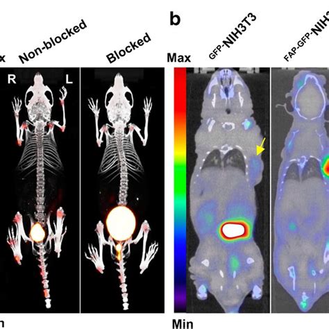 Preclinical Evaluation And Pilot Clinical Study Of 18F AlF NOTA FAPI