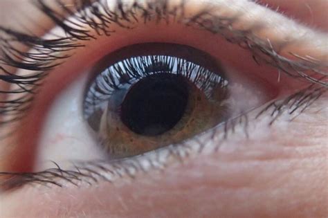 Glaucoma Una Enfermedad Silenciosa Que Deteriora La Calidad De Vida