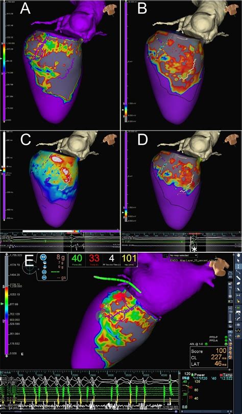 Ablación De Taquicardia Ventricular Guiada Por Cardiorresonancia Magnética Revista Española De