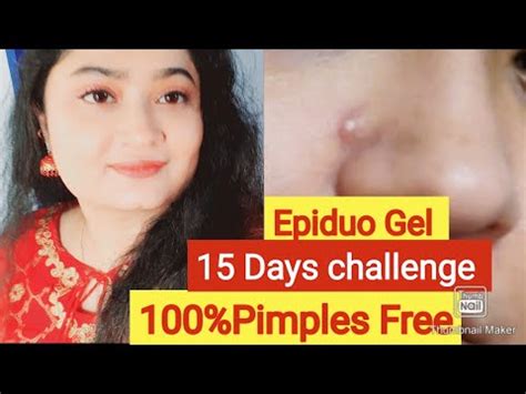 Epiduo Gel 15Days Challenge Review & Demo | Epiduo Gel How To Use ...