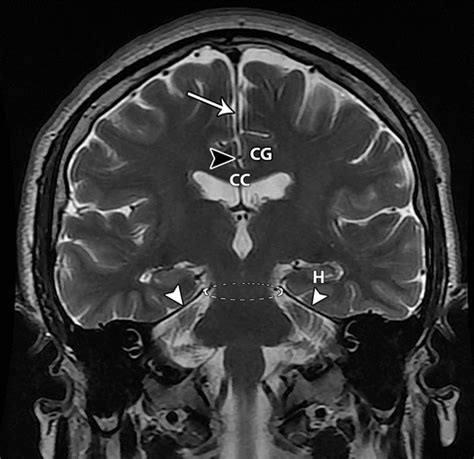 Cureus Brain Herniation Through The Cribriform Plate:, 56% OFF