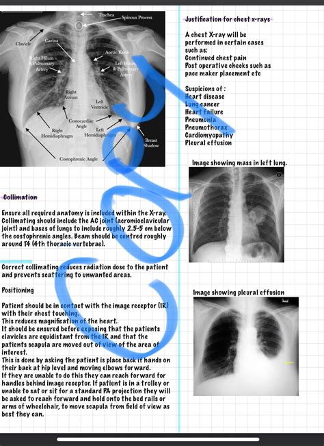 Carina Lung Xray