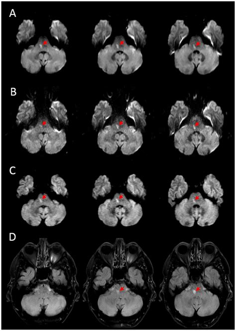 Representative Example Of Agreement Between Dwi Sequences For A Patient