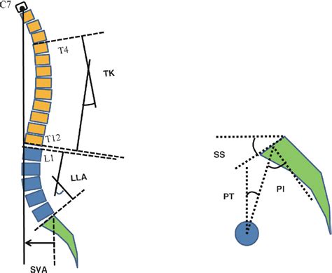 Figure 1 From Characteristics Of Sagittal Spino Pelvic Alignment In