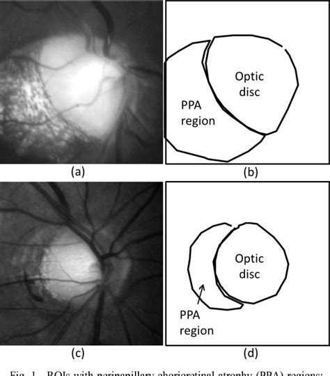 Peripapillary chorioretinal atrophy | Semantic Scholar