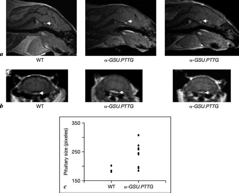 Evidence Of Pituitary Enlargement On Magnetic Resonance Images MRI In