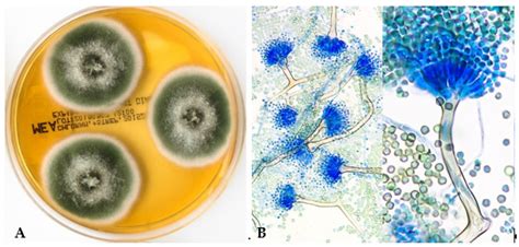 Diagnosis And Treatment Of Invasive Aspergillosis Caused By Non