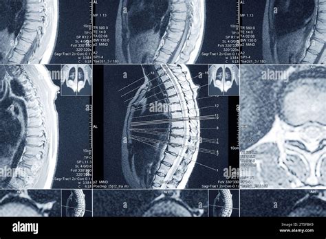 MRI Scan Of The Thoracic Spine For Diagnosis Medical Examination For