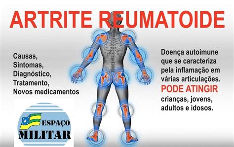 EspaÇo Militar Artrite Reumatoide Apenas 47 Dos Pacientes Procuram