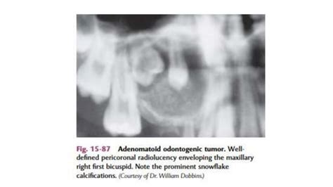 Adenomatoid Odontogenic Tumor Ppt