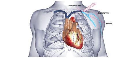 Cardiac Resynchronization Therapy Crt One Heart Cardiology