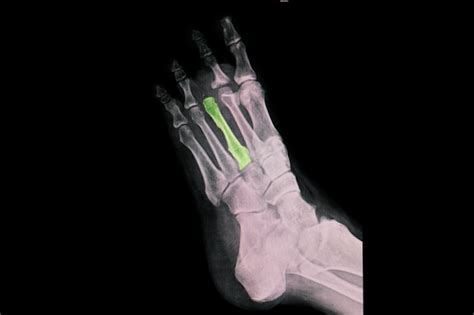 Premium Photo | A foot xray showing surgical amputation of third toe at ...