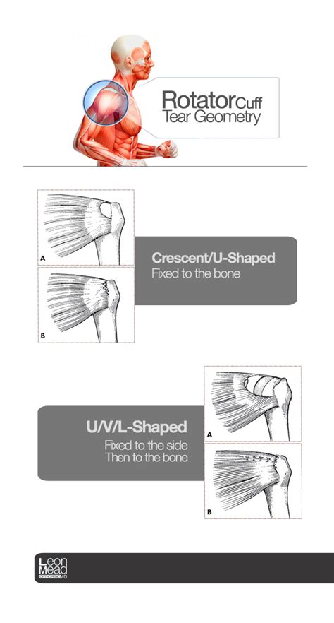 Rotator Cuff Tear Geometry Naples Orthopedic Doctor Leon Mead Md