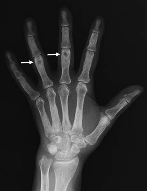 Polyostotic Fibrous Dysplasia Of Bone