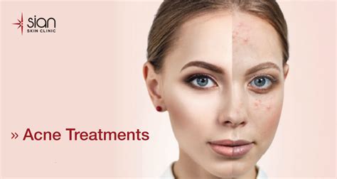 Acne Treatments with High Experience Dermatologists