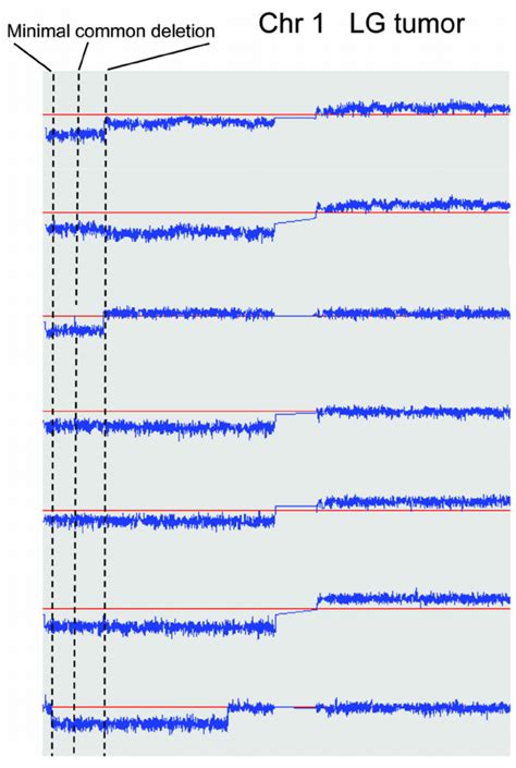 Minimal mapping of chromosome 1p hemizygous deletions in LG tumors ...