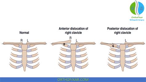 Sternoclavicular Joint Dislocation | OrthoFixar 2024