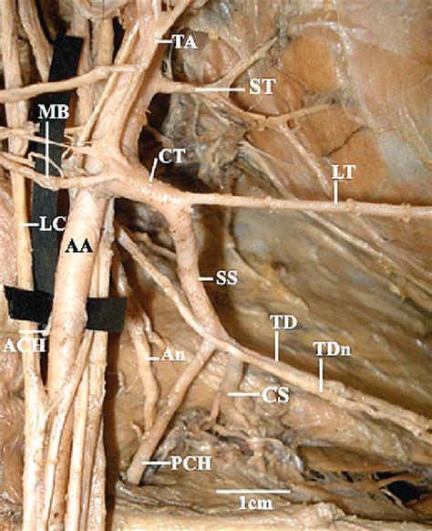 Subscapular Artery Cadaver