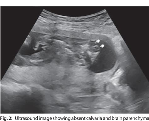 Figure 2 From Ultrasound Detection Of Fetal Structural Anomalies During