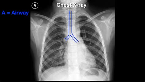 Read and Interpret Chest X-rays - The ABCDE Mnemonic Step-By-Step Practice — EZmed