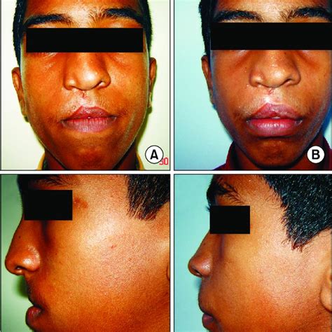 Clinical Photographs Of The Initial Anterior Maxillary Distraction