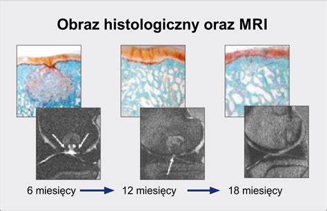 Rekonstrukcja chrząstki stawowej BioMatrix Chirurgia Kolana