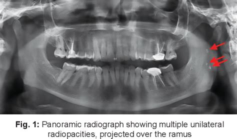 Tonsilloliths Radiograph