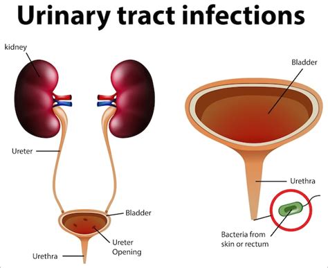 Premium Vector Informative Illustration Of Urinary Tract Infections