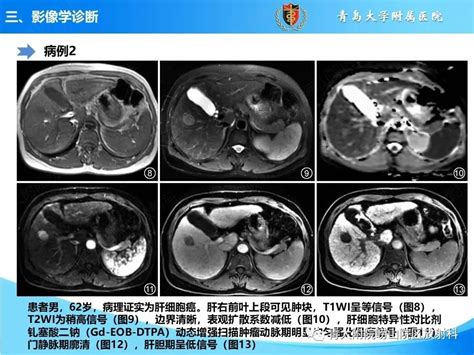 肝细胞癌的影像学诊断与鉴别诊断，总结太到位了 Medscicn