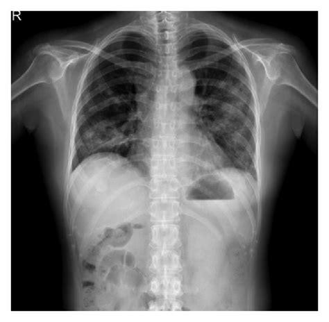 A Admission Anteroposterior Chest Radiography Shows Multilobar