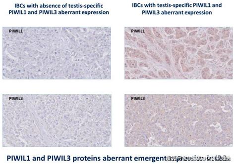 PIWI piRNA通路解除对浸润性乳腺癌的生物学意义 搜狐大视野 搜狐新闻