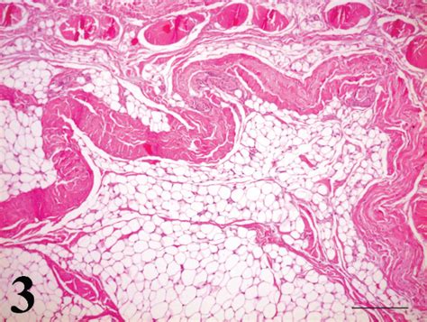 Histology Of Lipoma - Infoupdate.org