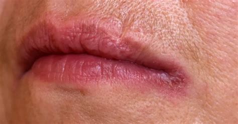 Angular Cheilitis: Causes, Symptoms, and Treatment | Byte®