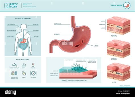 Peptic Ulcer And Helicobacter Pylori Infographic With Symptoms And