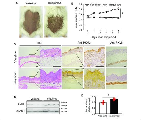 Pkm2 Expression Is Elevated In Imiquimod Imq Induced Psoriatic