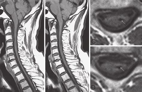 Figure1.Abnormal MRI findings. A: Cerebellar tonsils are displaced ...