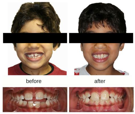 orthodontic habits  problems  kids hometown orthodontics