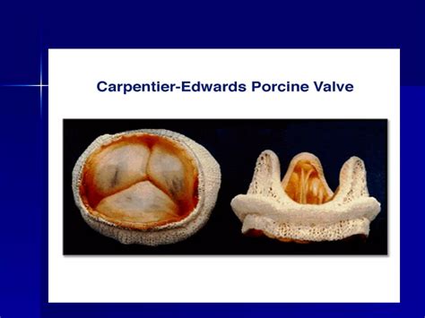 Prosthetic Heart Valves Ppt