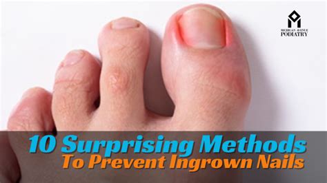 10 Surprising Methods To Prevent Ingrown Nails