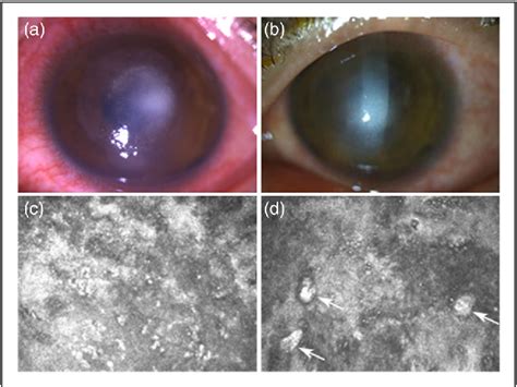 Figure 2 From Polymicrobial Keratitis After Accelerated Corneal Collagen Cross Linking In