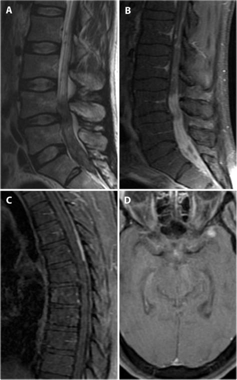 Malignant Peripheral Nerve Sheath Tumor Of The Cauda Equina With