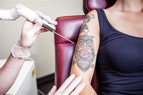 Laser Tattoo Removal FAQ - Missoula, MT Questions and Answers on Eliminating Ink