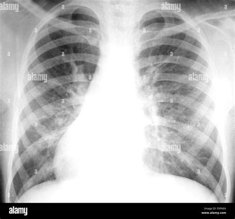 Broken rib patient hi-res stock photography and images - Alamy