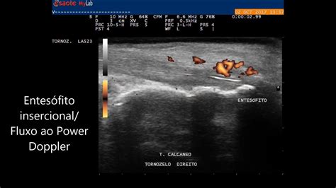 Entesófito Plantar No Calcâneo Braincp