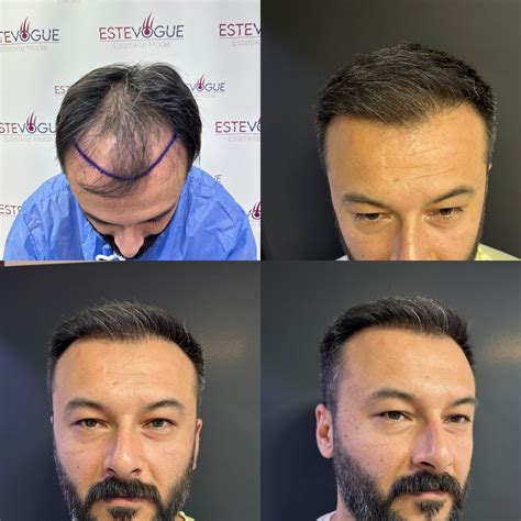 Hair Transplant In Turkey Plastic Surgery Supervised Hair Transplant