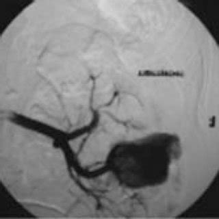 PDF Pseudoaneurisma arteria renal postnefrectomía parcial