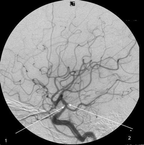 Cerebral Vasculitis Presenting As A Stroke Bmj Case Reports