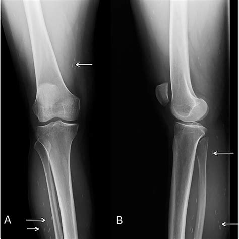 Anteroposterior And Lateral Radiographs Of The Right Knee Download Scientific Diagram